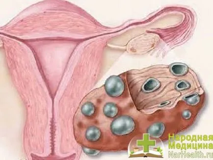 Hiperandrogenism la femei - simptome, cauze, tratament de origine suprarenale (simptome) Hiperandrogenism la femei - simptome, cauze, tratamentul genezei suprarenale