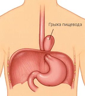 Simptomele herniei esofagiene și tratamentul remedii populare (populare) simptome hernie hiatala si tratamentul de remedii populare