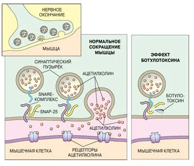 Botox-ul este Botox este dăunătoare pentru o persoană (consecințele)