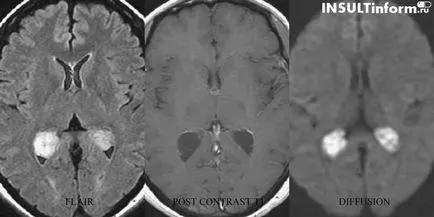 Accident vascular cerebral la copii cauze, simptome, efecte și metode de tratament (accident vascular cerebral) Accident vascular cerebral la copii cauze, simptome, efecte și metode de tratament