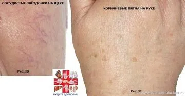 Cum rănit Splina simptome - sfaturi și răspunsuri (durere) Cum rănit Splina simptome - sfaturi și răspunsuri