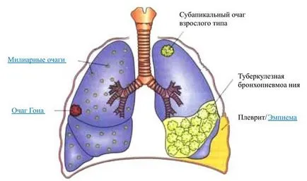 Cum rănit plămânii simptomele față în timpul inhalării la om, tuse (simptome) Cum rănit plămânii simptomele față în timpul inhalării la om, tuse