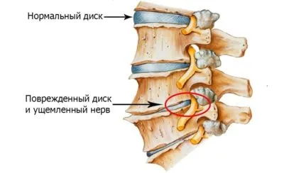 Cum de a consolida în mod corespunzător mușchii gâtului cu osteohondroza (consolidarea) Cum de a consolida în mod corespunzător mușchii gâtului cu osteohondroză