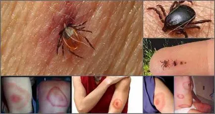 Care sunt efectele unui om de căpușă muscatura (efecte) Care sunt efectele înțepătura de căpușă la om