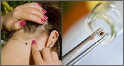 Care sunt efectele unui om de căpușă muscatura (muscatura) Care sunt efectele înțepătura de căpușă la om