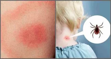Care sunt efectele unui om de căpușă muscatura (bifați) Care sunt efectele înțepătura de căpușă la om
