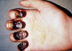antibiotice analize de sânge antibiotice analize de sânge