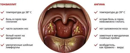 Cum de a trata glandele - ce se întâmplă dacă amigdalelor inflamat (tratament) Cum de a trata glandele - ce se întâmplă dacă amigdalele inflamat