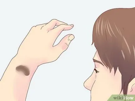 Cum de a ușura nevilor mod natural (spot) Cum de a ușura în mod natural birthmarks