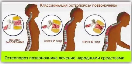 Cum de a trata osteoporoza remedii populare la domiciliu