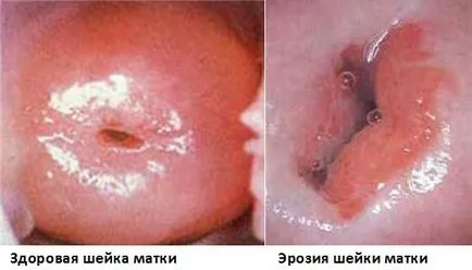 Cum de a cauteriza metode de eroziune de col uterin, senzație de efectele, prevenirea complicațiilor