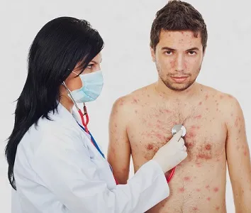 Care sunt simptomele de varicela la copii si adulti cu simptome ale fotografiei (copii văzut vărsat de vânt) Care sunt simptomele de varicela la copii si adulti cu simptome de fotografii