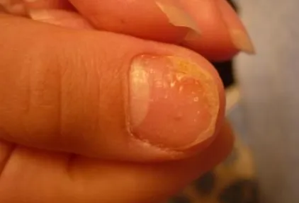 Cum se distinge ciuperca pe o parte, la etapa inițială, boli fungice (recunosc) Cum se distinge ciuperca pe o parte, la etapa inițială, boli fungice
