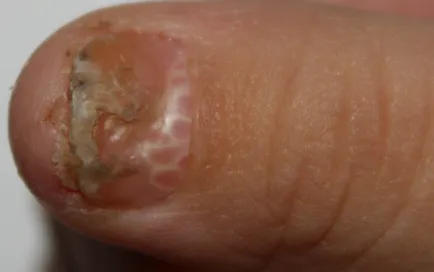 Cum se distinge ciuperca pe o parte, la etapa inițială, boli fungice (ciuperci) Cum se distinge ciuperca pe o parte, la etapa inițială, boli fungice