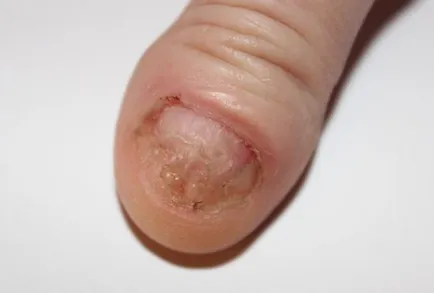 Cum se distinge ciuperca pe o parte, la etapa inițială, boli fungice (mâini) Cum se distinge ciuperca pe o parte, la etapa inițială, boli fungice