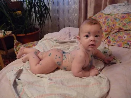 Care sunt simptomele de varicela la copii si adulti cu simptome ale fotografiei (observate) Care sunt simptomele de varicela la copii si adulti cu simptome de fotografii
