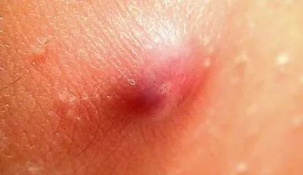Cum de a elimina firele de păr crescute sub piele și pentru a reduce inflamația (costurile de chirurgie) Cum de a elimina firele de păr crescute sub piele și pentru a reduce inflamația
