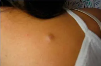 Care este cauza si simptomele shipitsa aspectul