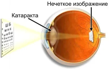 Cum de a vindeca o cataractă fără intervenție chirurgicală căi de atac folk
