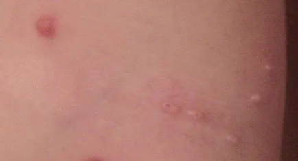 Ce este molluscum contagiosum, și dacă eliminarea acesteia, creșterile de piele au nevoie (molluscum contagiosum) Ce este molluscum contagiosum, și dacă doriți să-l ștergeți, excrescente pe piele