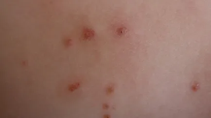 Ce este molluscum contagiosum, și dacă se îndepărtează, excrescențele pielii trebuie sa (uite) Ce este molluscum contagiosum, și dacă doriți să-l ștergeți, excrescente pe piele