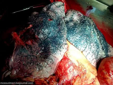 Cum sunt organele interne ale fumătorului (foto pulmonar fumatori)