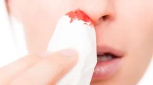 Cum de a provoca o nosebleed rapid, în condiții de siguranță și fără durere (sânge) Cum de a provoca o nosebleed rapid, în condiții de siguranță și fără durere