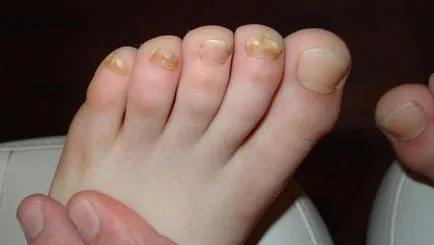 Cum se afișează o ciuperca toenail (unghii) Cum pentru a afișa o ciuperca unghiilor de la picioare