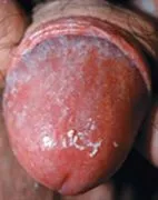 Candidoza (afte) - cauze, simptome, diagnostic, tratament, complicații și prevenirea ciuperci