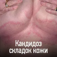 Candidoza (afte) - cauze, simptome, diagnostic, tratament, complicații și prevenirea ciuperci