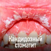 Candidoza (afte) - cauze, simptome, diagnostic, tratament, complicații și prevenirea ciuperci