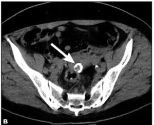 uterin calcificat fibroamelor particularități de tratament și de dezvoltare