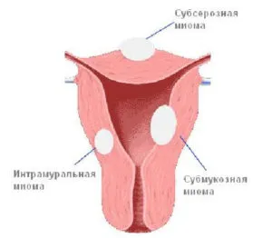 uterin calcificat fibroamelor particularități de tratament și de dezvoltare