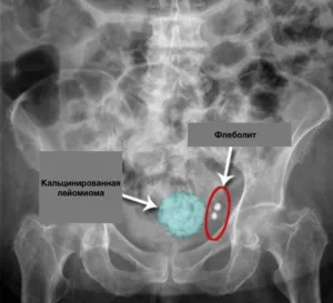 uterin calcificat fibroamelor particularități de tratament și de dezvoltare