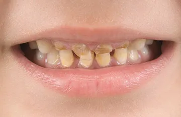 cariilor dentare lapte - primele semne și metode de tratament
