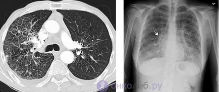 carcinomatoza peritoneala (cavitatea abdominală), plămân - tratament, prognostic