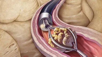 Pietrele din cauzele ureter, simptome și tratament (tratament) Pietrele din ureter cauze, simptome și tratament