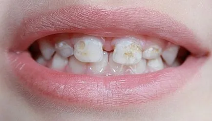 cariilor dentare lapte - primele semne și metode de tratament