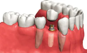 Proteza sau implantare