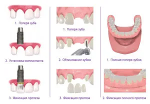 Proteza sau implantare