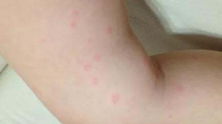 Copilul are o erupție care poate fi Copilul are o erupție care poate fi