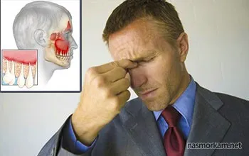 chist sinus maxilar cauze, tratament