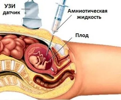 Chist plex vascular al creierului unei cauze nou-nascuti si tratament (un nou-născut) Chist plexul vascular al creierului cauzelor nou-născuți și tratamentul