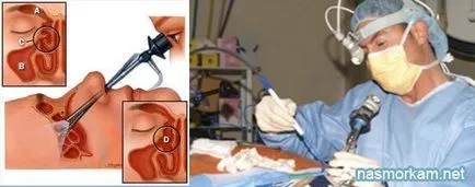 chist sinus maxilar cauze, tratament