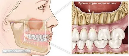chist sinus maxilar cauze, tratament