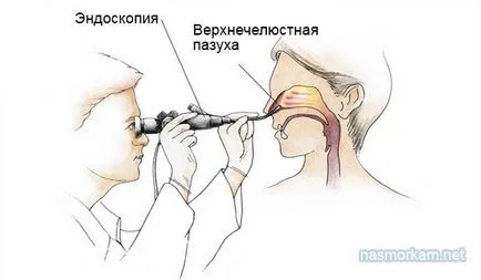 chist sinus maxilar cauze, tratament