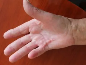 Simptomele Dupuytren contractura si tratamentul la domiciliu (tratament) Simptomele maladia Dupuytren și tratament la domiciliu