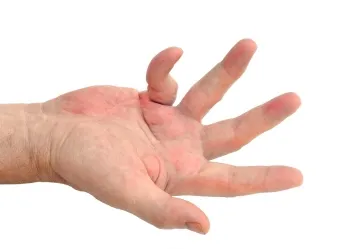 remedii populare tratament la domiciliu - contractura Dupuytren