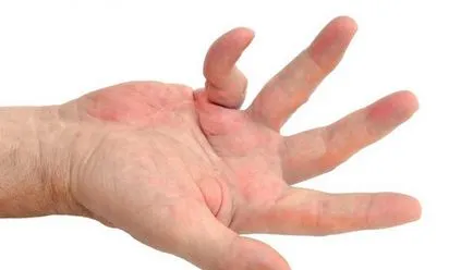 Contractura mușchilor și articulațiilor cauze, tratament (contractura) Contractura mușchilor și a articulațiilor, cauze, tratament