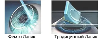 Vision Metoda de corecție femtolasik (IntraLASIK) IRTC Vision Metoda de corecție femtolasik (IntraLASIK) IRTC
